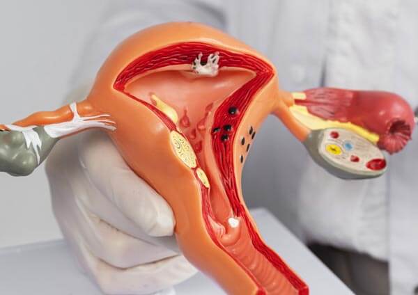 Maqueta de un útero con adenomiosis