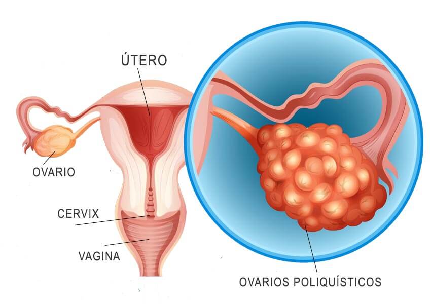 Infografía del síndrome de los ovarios poliquísticos