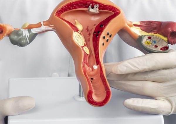endometriosis-esquema (1)